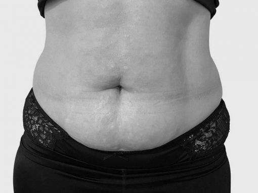 Body Shaping Treatments  Non Surgical Body Shaping & Sculpting